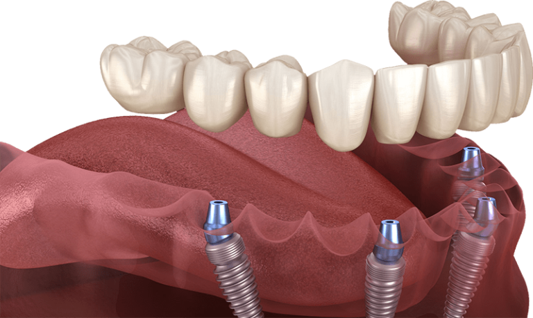 Dental-Implants-min